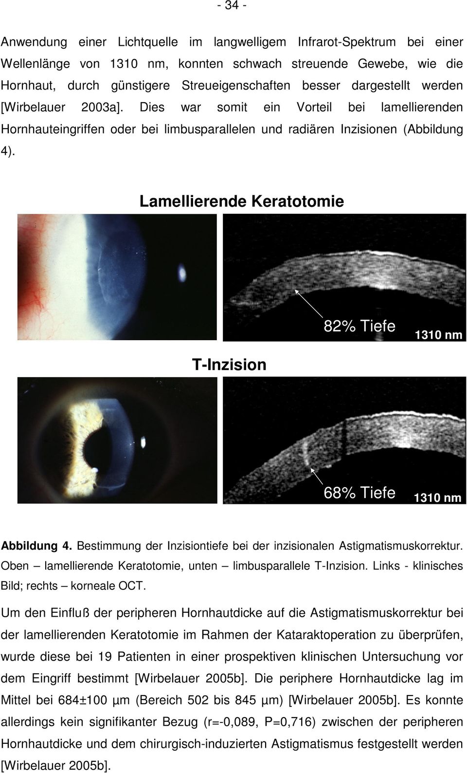 Lamellierende Keratotomie 82% Tiefe 1310 nm T-Inzision 68% Tiefe 1310 nm Abbildung 4. Bestimmung der Inzisiontiefe bei der inzisionalen Astigmatismuskorrektur.