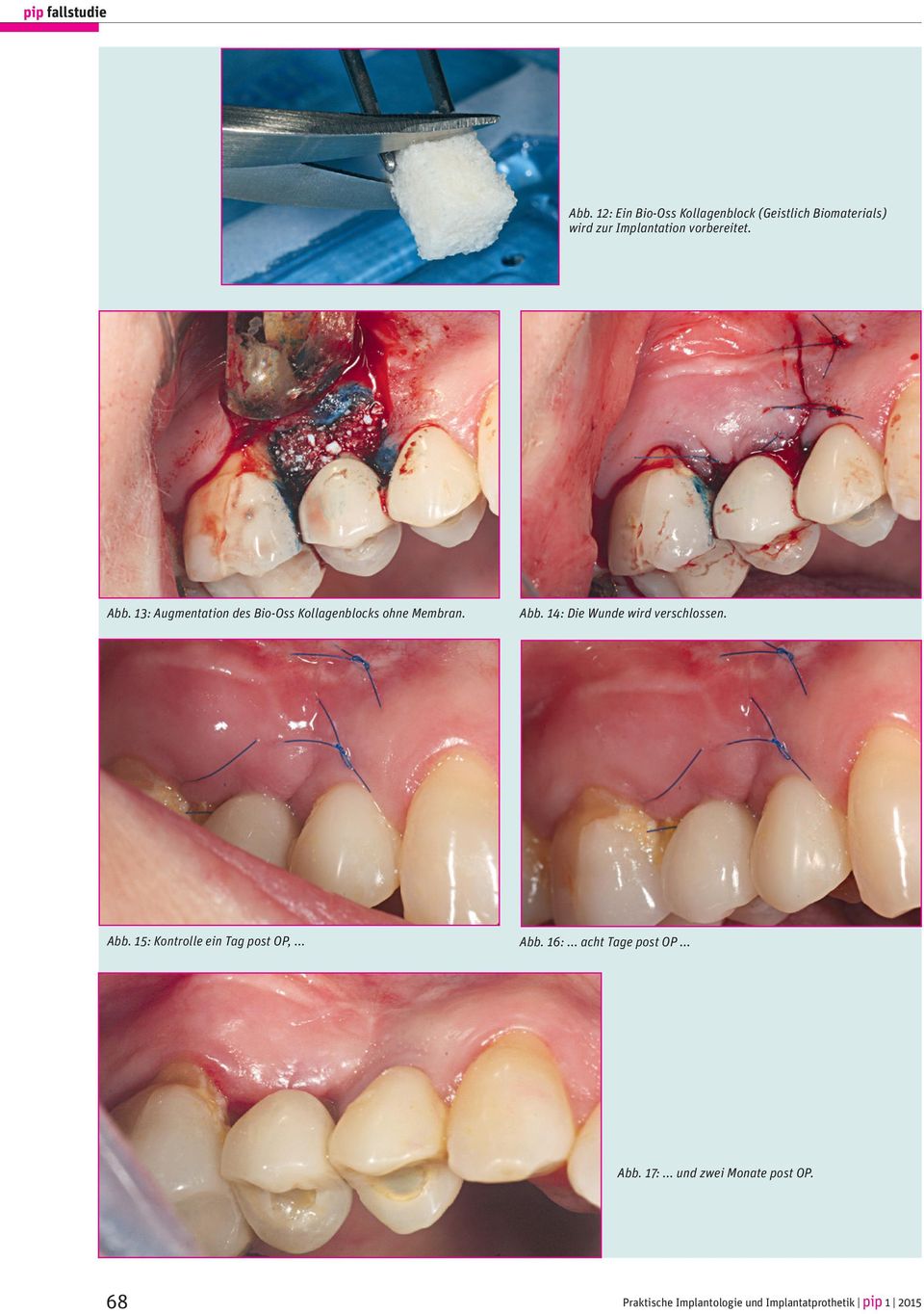 Abb. 15: Kontrolle ein Tag post OP,... Abb. 16:... acht Tage post OP... Abb. 17:.