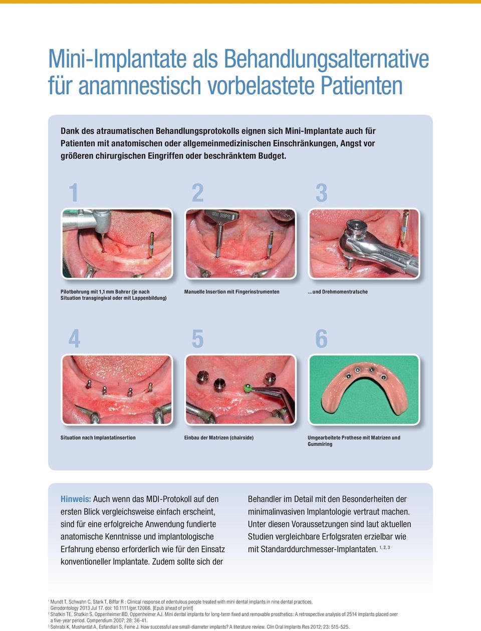 1 2 3 Pilotbohrung mit 1,1 mm Bohrer (je nach Situation transgingival oder mit Lappenbildung) Manuelle Insertion mit Fingerinstrumenten.