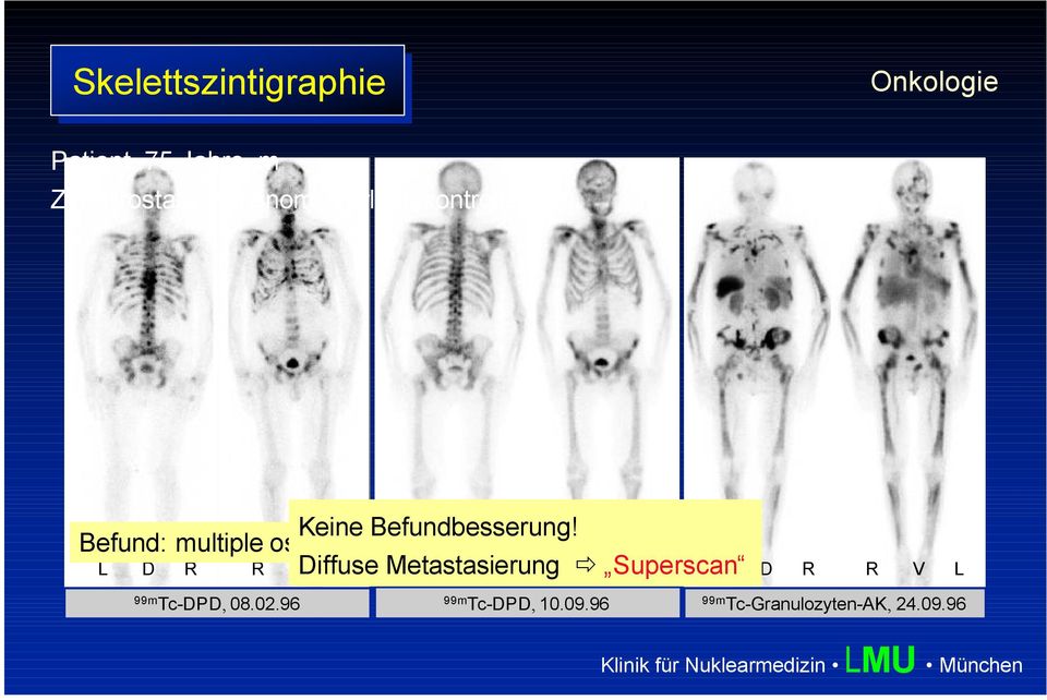 Metastasierung L D R R Superscan V L L D R R V L 99m Tc-DPD, 08.02.