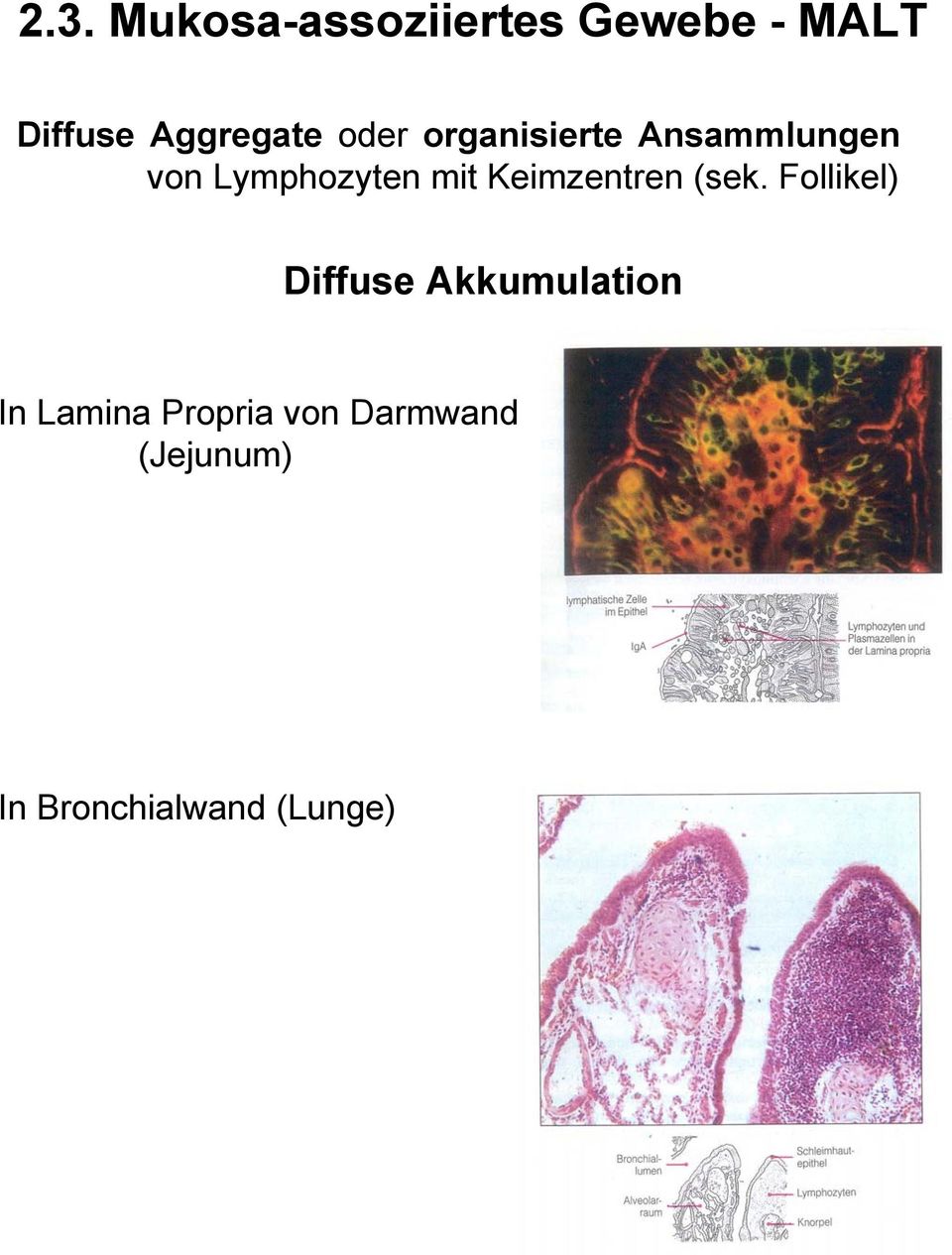 Lymphozyten mit Keimzentren (sek.