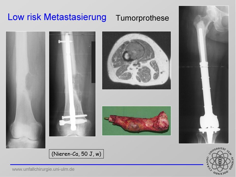 Tumorprothese