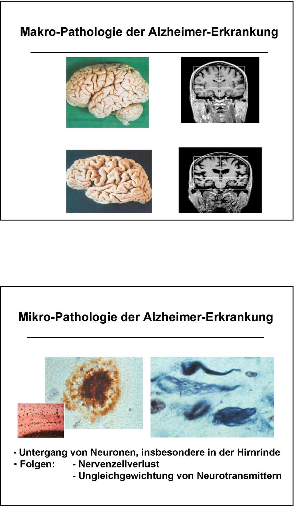 Neurofibrillen Untergang von Neuronen, insbesondere in der