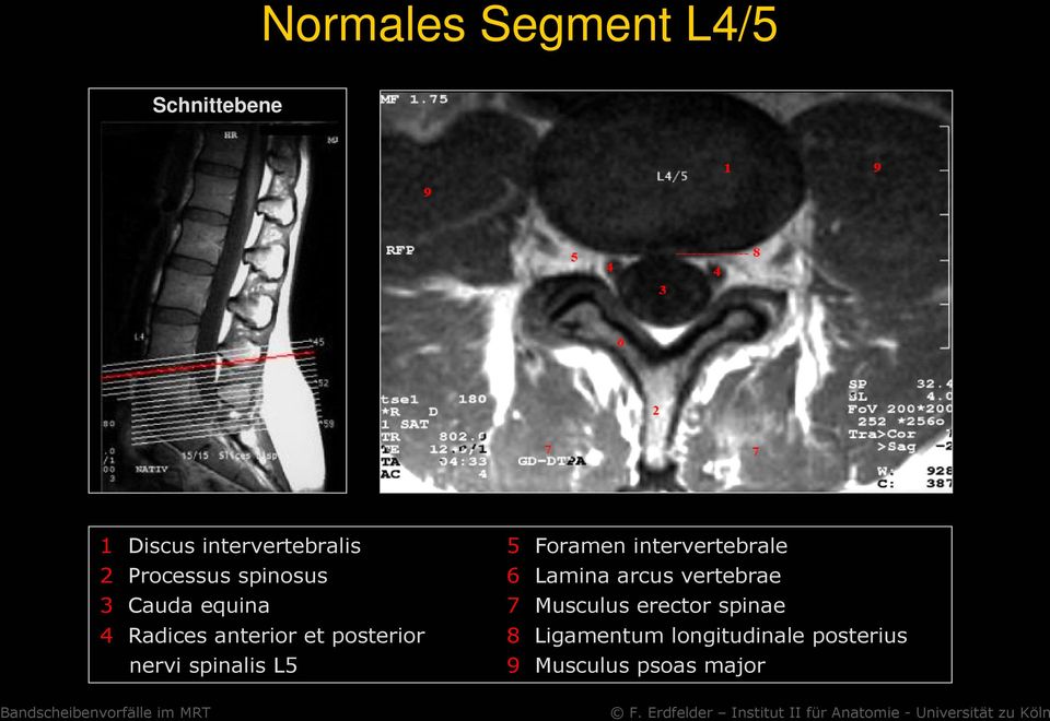 equina 7 Musculus erector spinae 4 Radices anterior et posterior 8