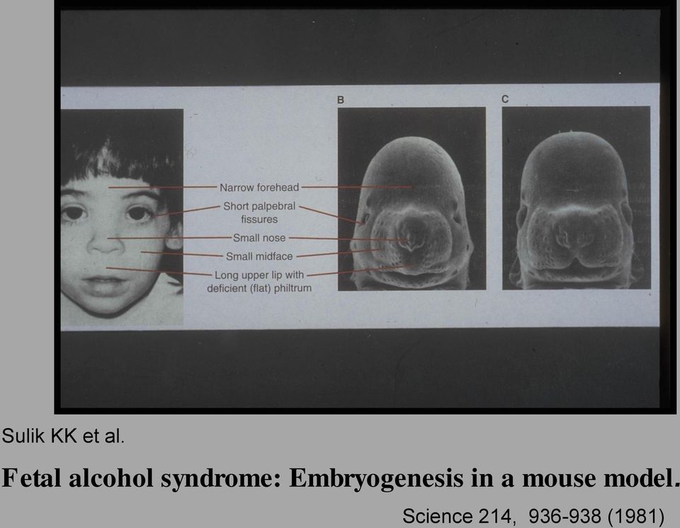 Fetal alcohol syndrome: