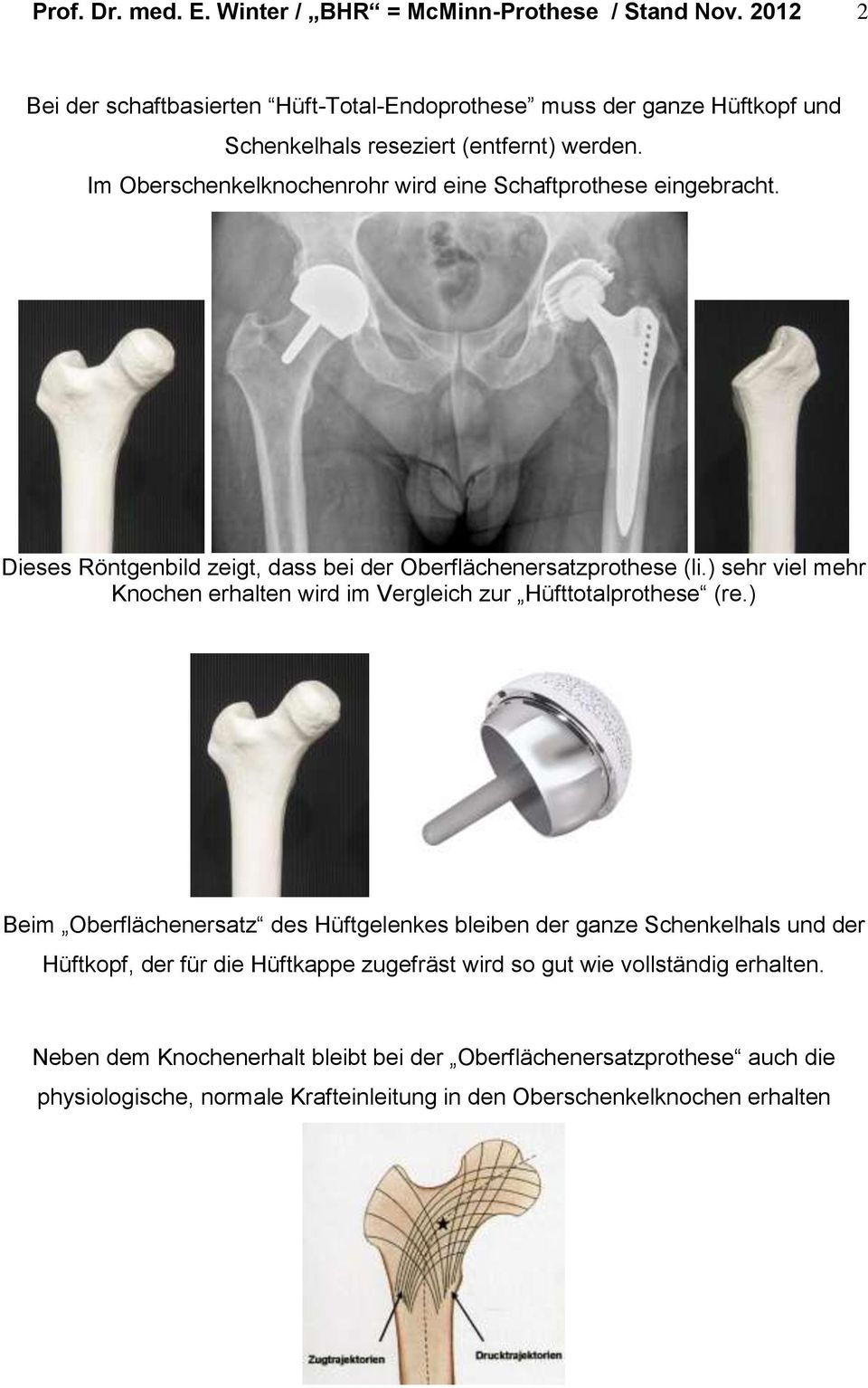 Im Oberschenkelknochenrohr wird eine Schaftprothese eingebracht. Dieses Röntgenbild zeigt, dass bei der Oberflächenersatzprothese (li.