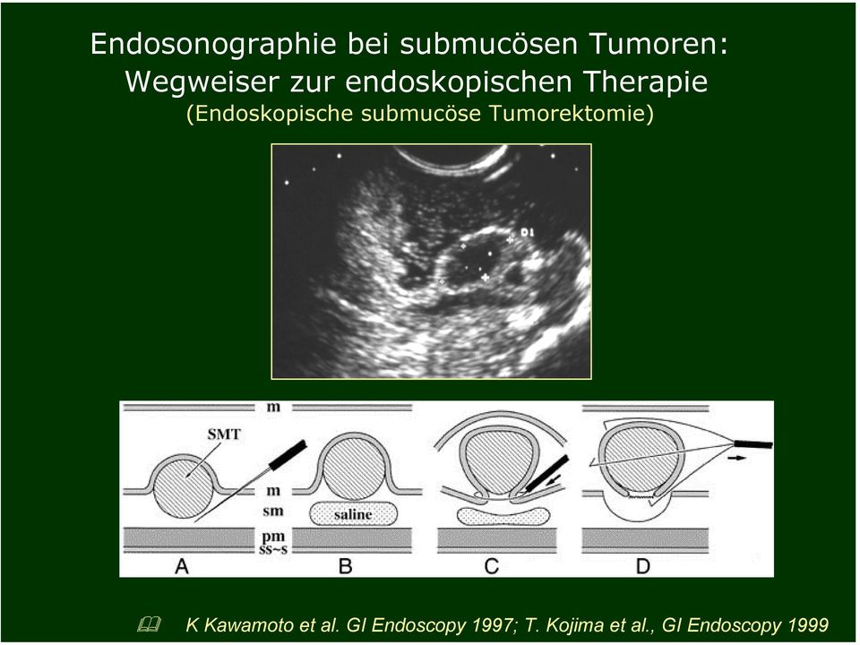 (Endoskopische submucöse Tumorektomie) K