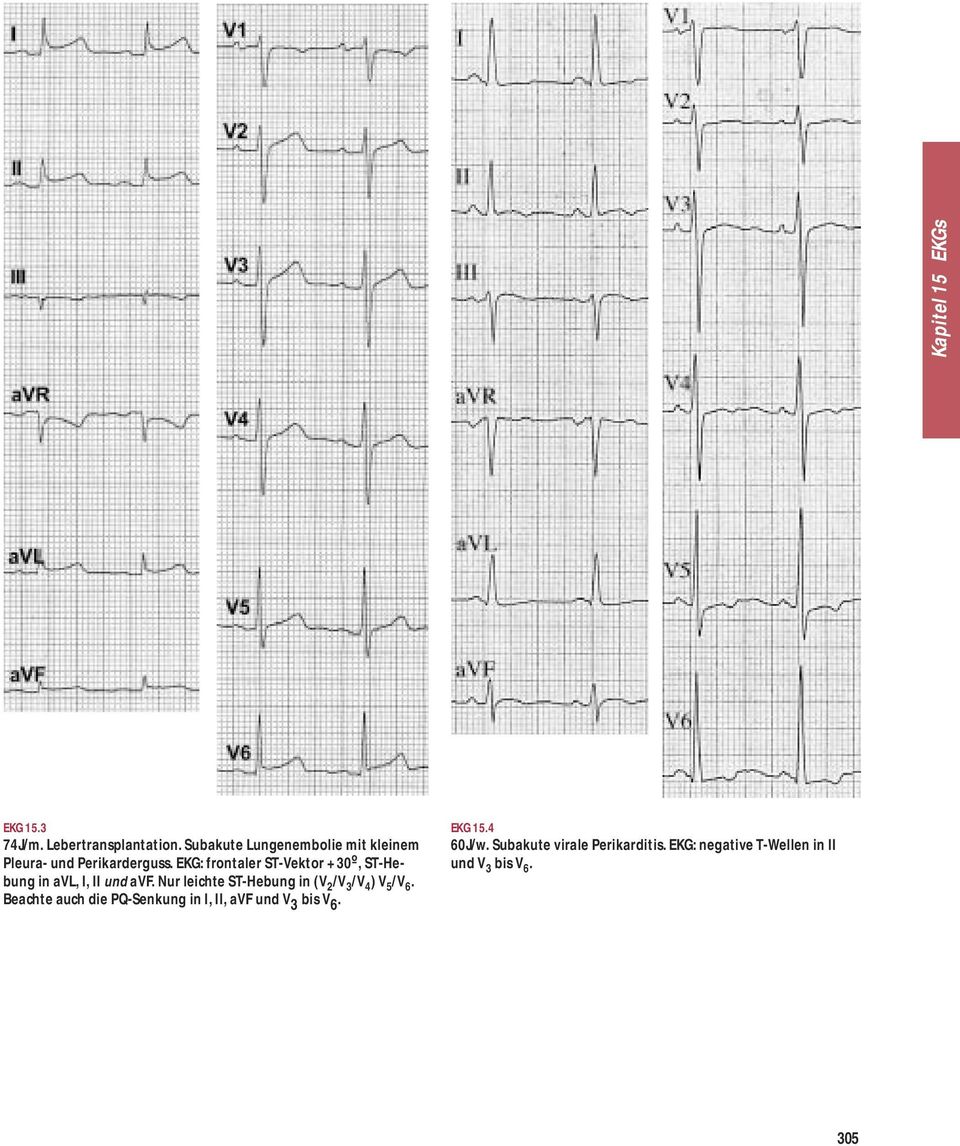 EKG: frontaler ST-Vektor +30º, ST-Hebung in avl, I, II und avf.