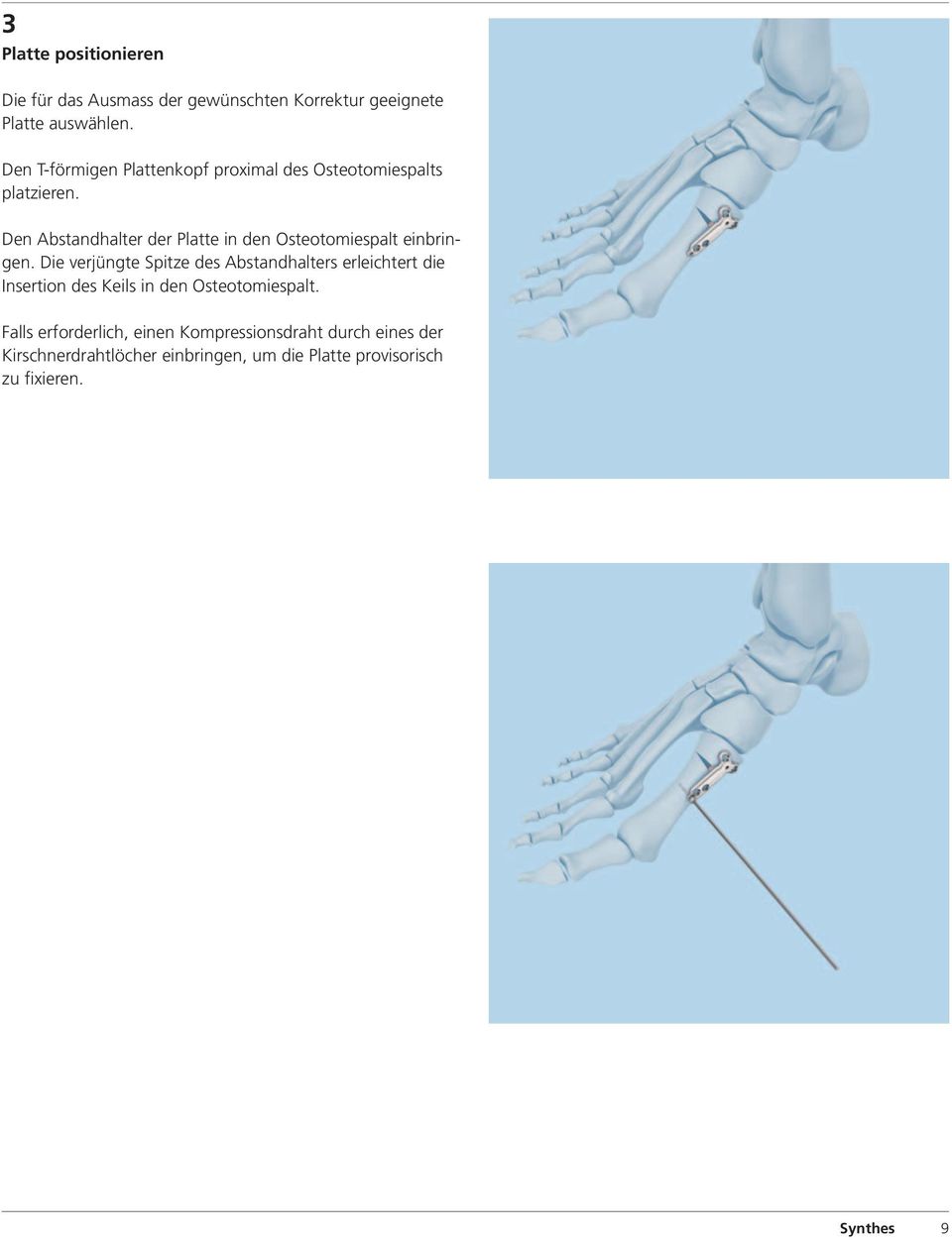 Den Abstandhalter der Platte in den Osteotomiespalt einbringen.