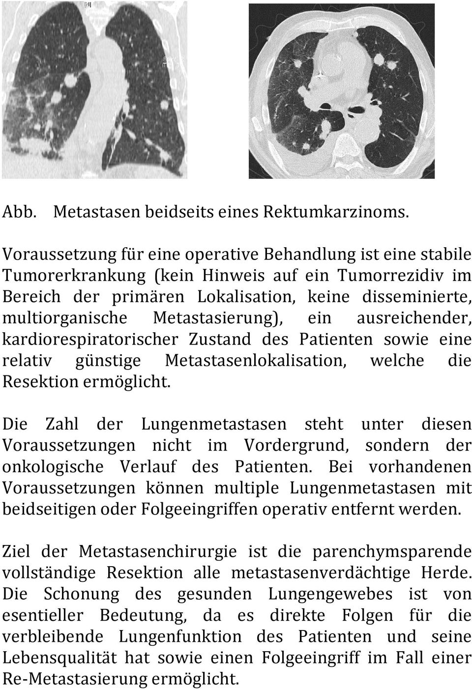 Metastasierung), ein ausreichender, kardiorespiratorischer Zustand des Patienten sowie eine relativ günstige Metastasenlokalisation, welche die Resektion ermöglicht.