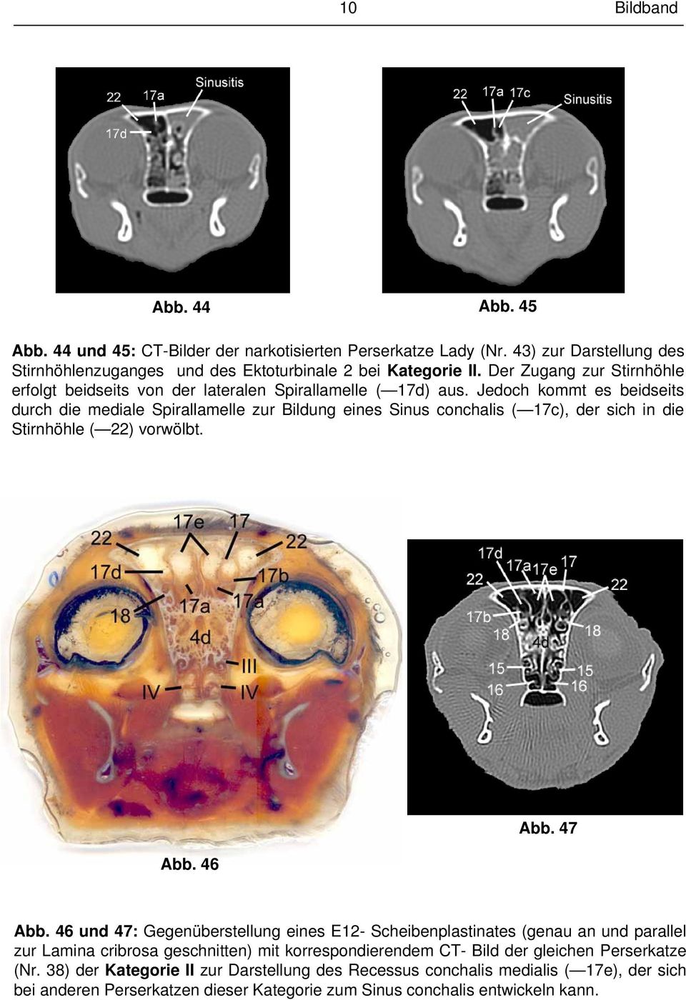 Jedoch kommt es beidseits durch die mediale Spirallamelle zur Bildung eines Sinus conchalis ( 17c), der sich in die Stirnhöhle ( 22) vorwölbt. Abb. 46 Abb. 47 Abb.