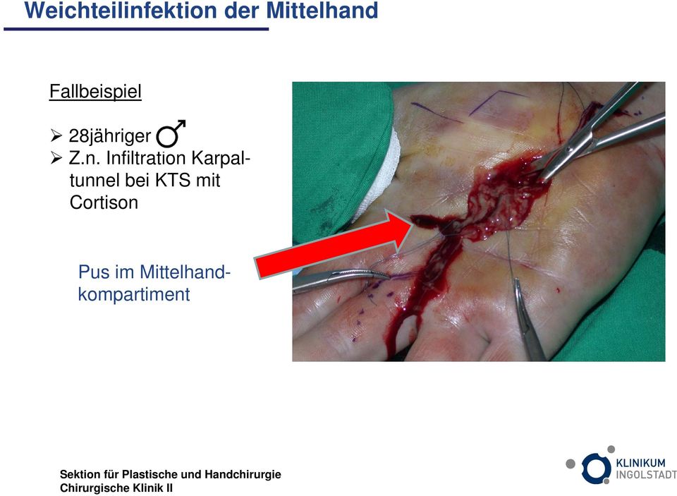 Infiltration Karpaltunnel bei KTS