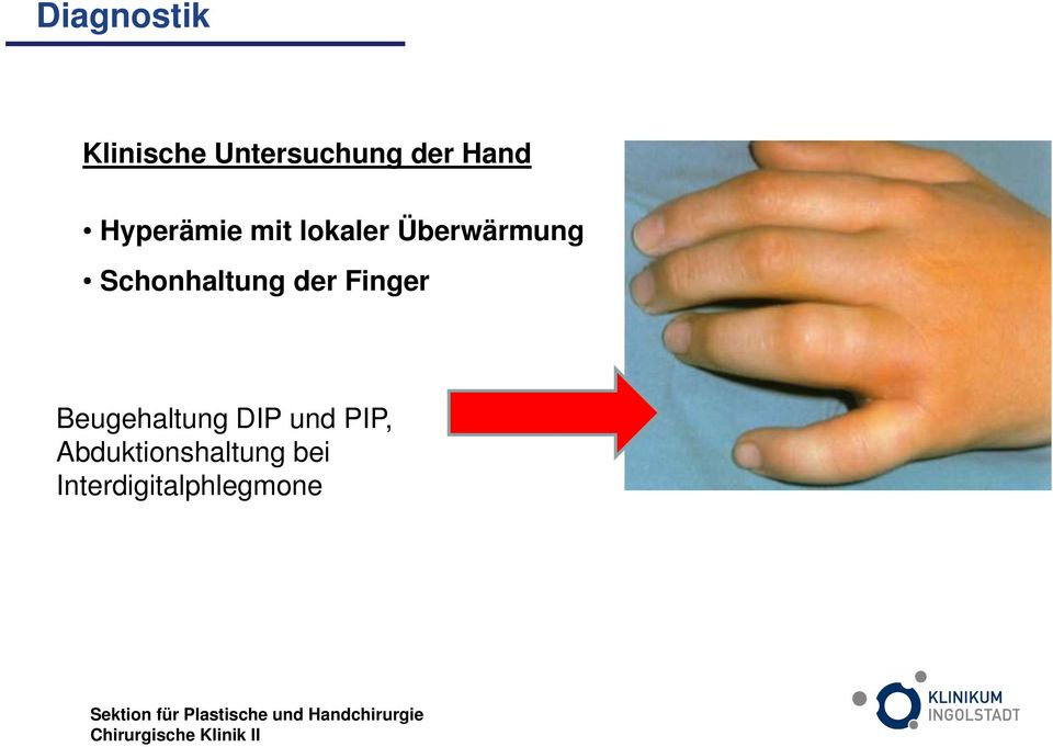 Schonhaltung der Finger Beugehaltung DIP