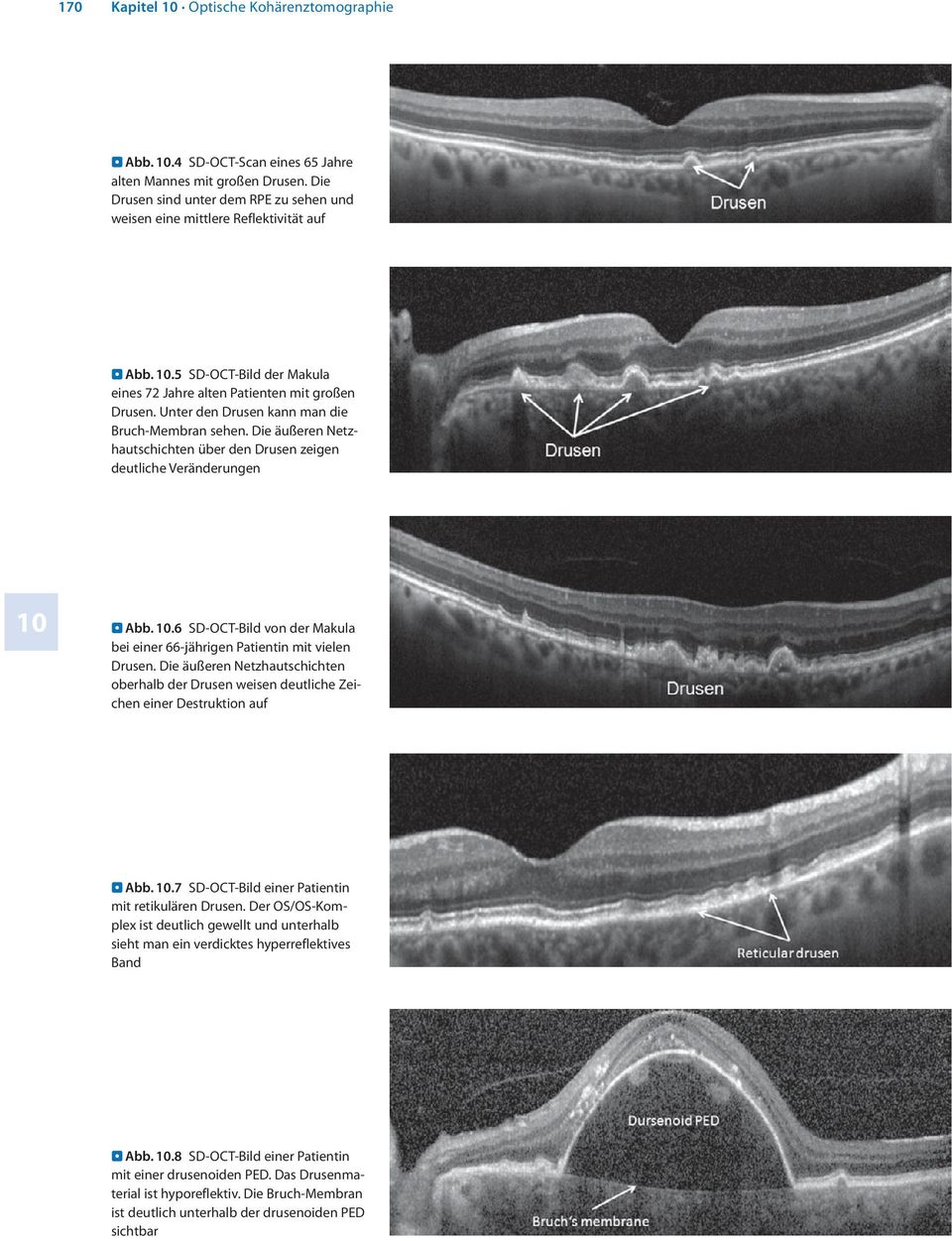 Die äußeren Netzhautschichten über den Drusen zeigen deutliche Veränderungen 10 Abb. 10.6 SD-OCT-Bild von der Makula bei einer 66-jährigen Patientin mit vielen Drusen.