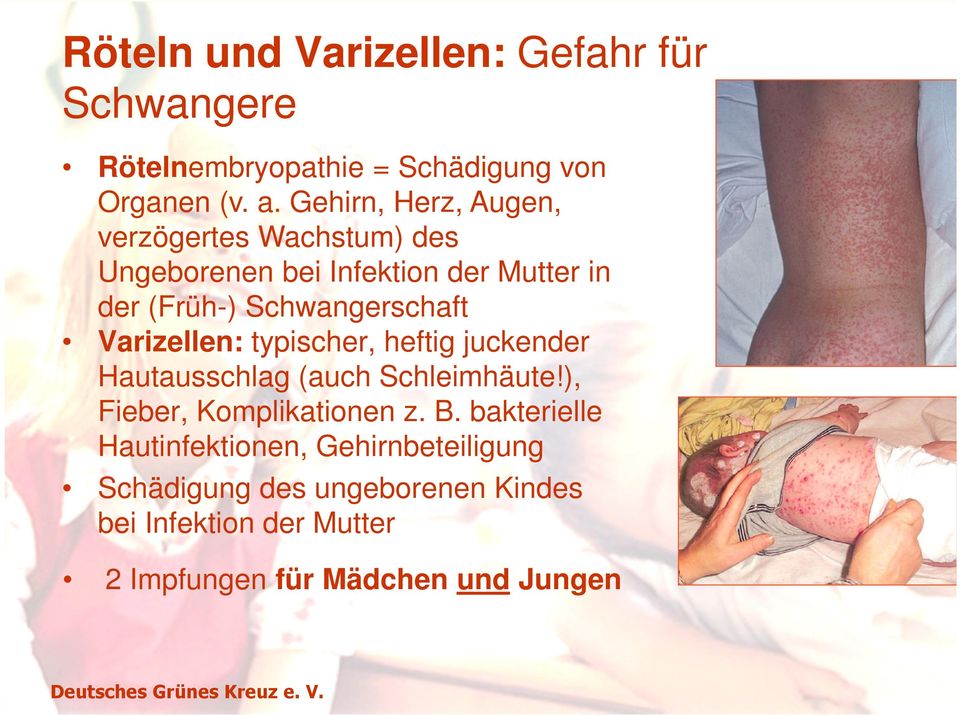 Schwangerschaft Varizellen: typischer, heftig juckender Hautausschlag (auch Schleimhäute!