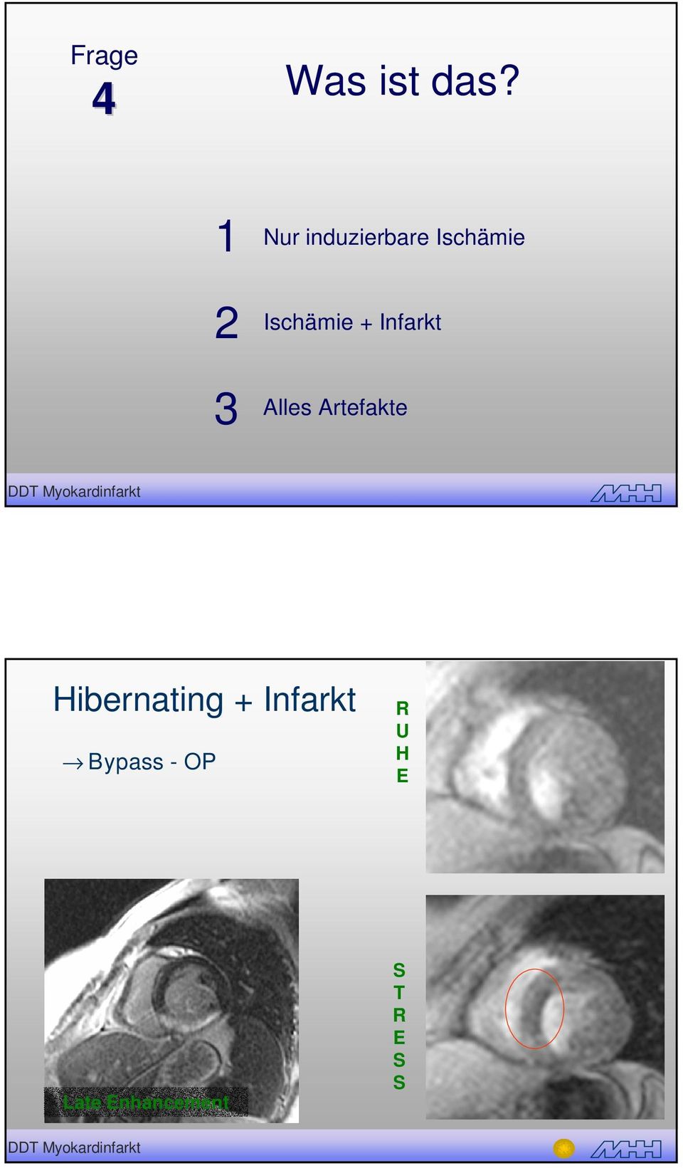 Ischämie + Infarkt Alles Artefakte