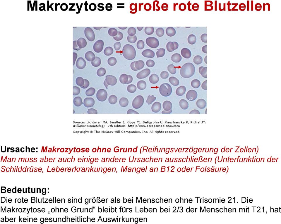 Mangel an B12 oder Folsäure) Bedeutung: Die rote Blutzellen sind größer als bei Menschen ohne Trisomie 21.