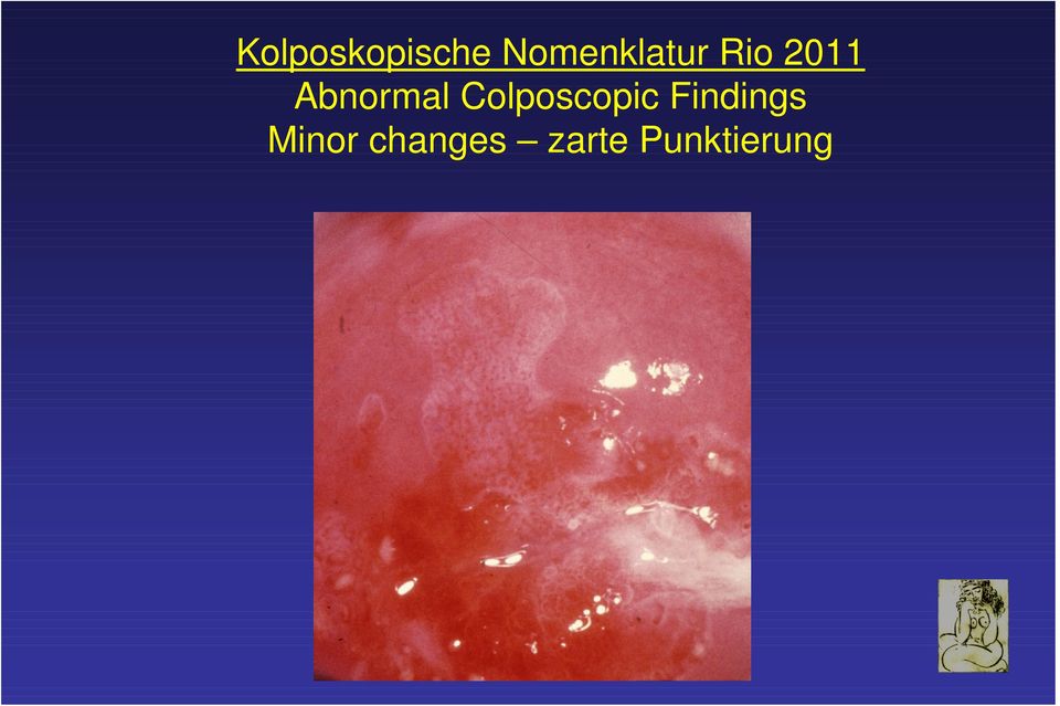 Abnormal Colposcopic