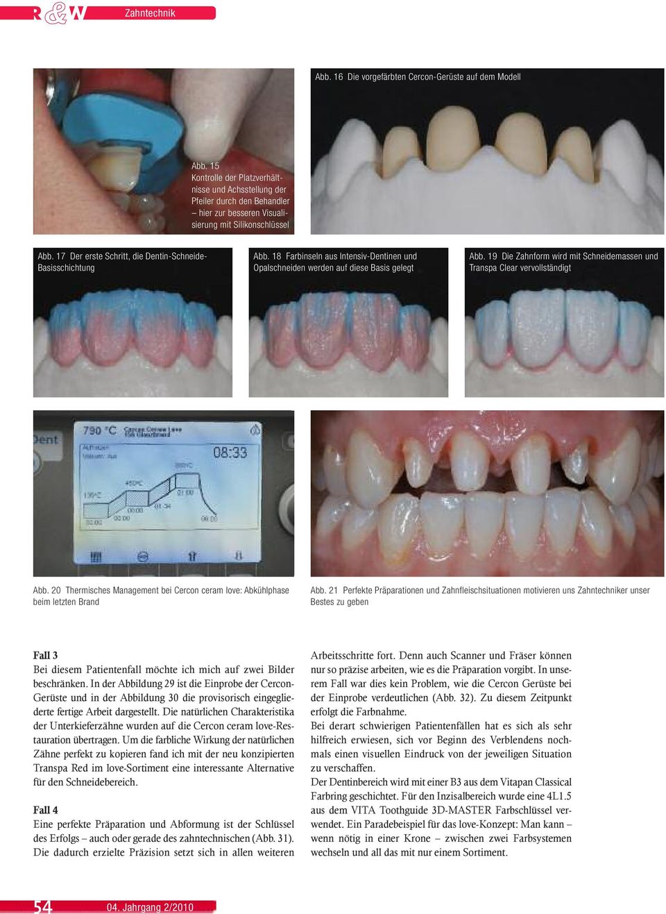 17 Der erste Schritt, die Dentin-Schneide- Basisschichtung Abb. 18 Farbinseln aus Intensiv-Dentinen und Opalschneiden werden auf diese Basis gelegt Abb.