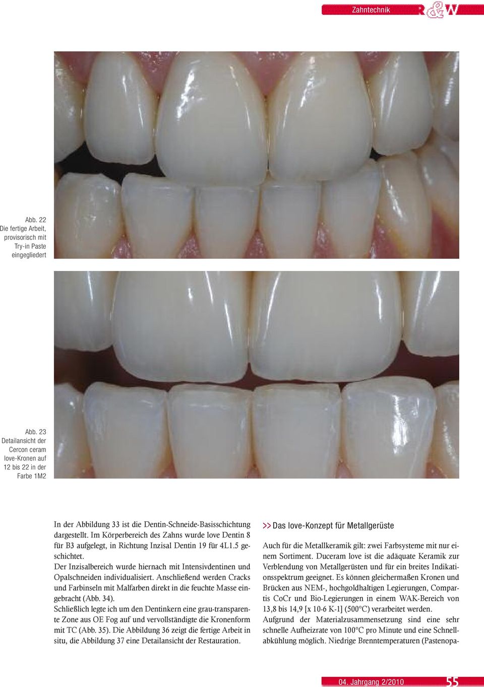 Im Körperbereich des Zahns wurde love Dentin 8 für B3 aufgelegt, in Richtung Inzisal Dentin 19 für 4L1.5 geschichtet.