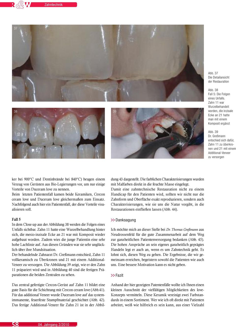Greßmann entschied sich dafür, Zahn 11 zu überkronen und 21 mit einem Additional-Veneer zu versorgen ker bei 900 C und Dentinbrände bei 840 C) beugen einem Verzug von Gerüsten aus Bio-Legierungen