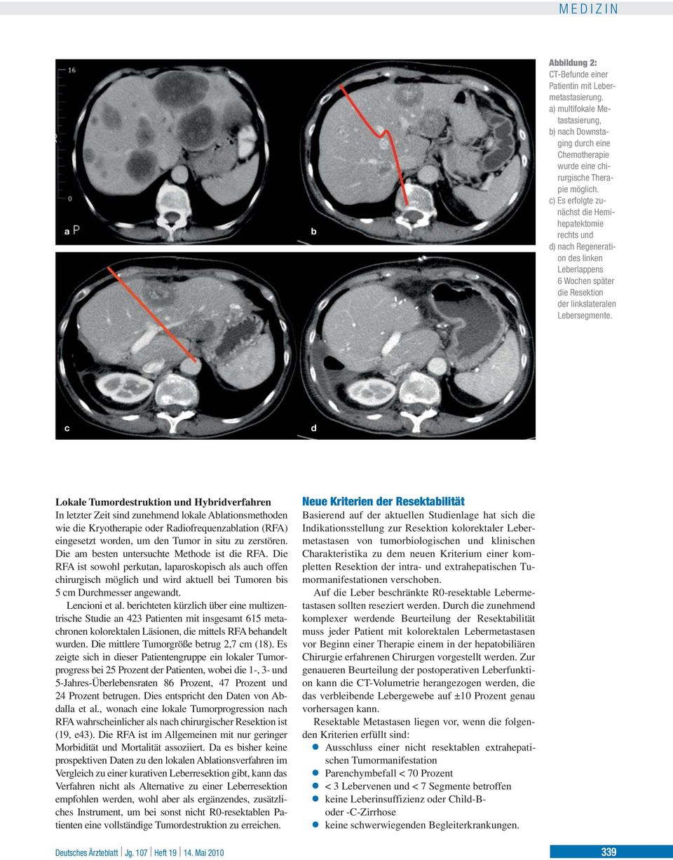 c d Lokale Tumordestruktion und Hybridverfahren In letzter Zeit sind zunehmend lokale Ablationsmethoden wie die Kryotherapie oder Radiofrequenzablation (RFA) eingesetzt worden, um den Tumor in situ