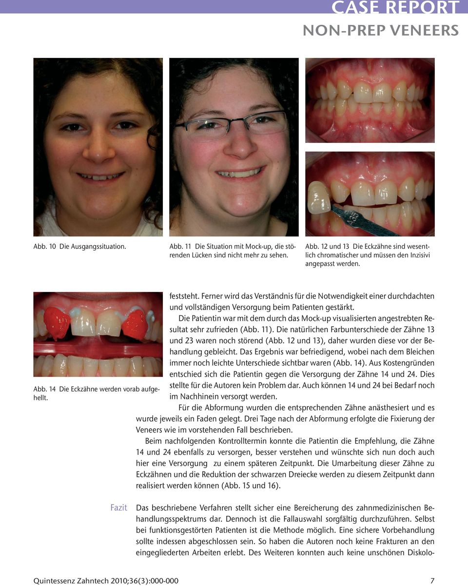 Die Patientin war mit dem durch das Mock-up visualisierten angestrebten Resultat sehr zufrieden (Abb. 11). Die natürlichen Farbunterschiede der Zähne 13 und 23 waren noch störend (Abb.