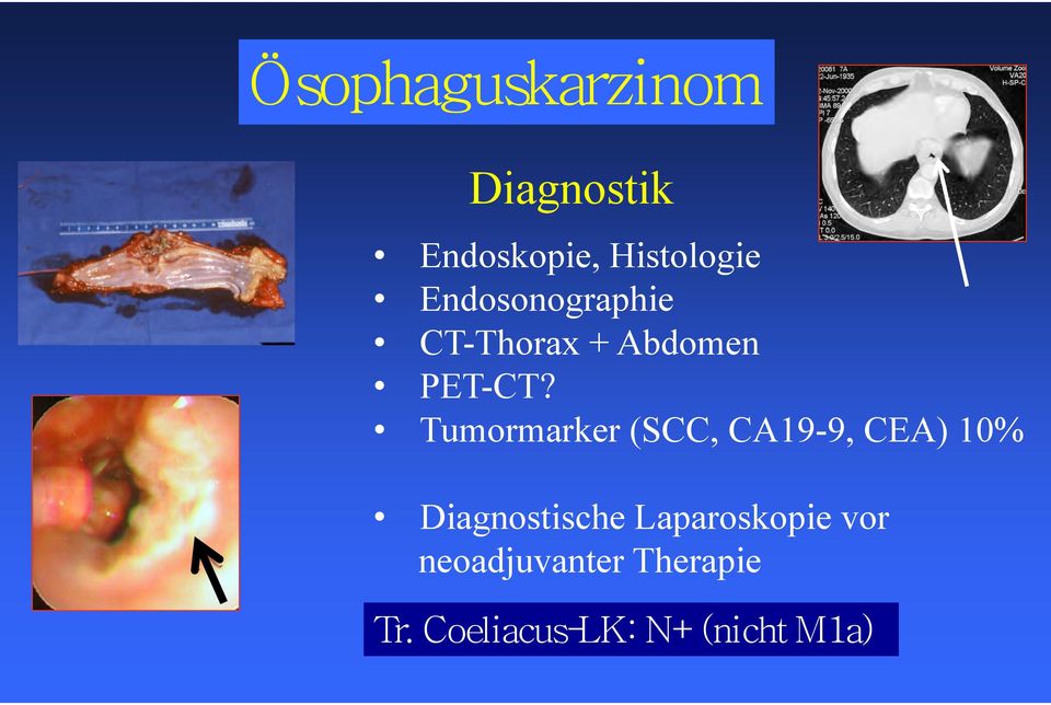 Tumormarker (SCC, CA19-9, CEA) 10% Diagnostische