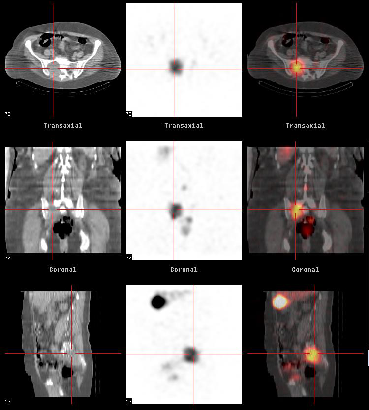 Abb.7 Radioiod-SPECT/CT bei Knochenmetastasen: Patientin mit follikulärem Schilddrüsenkarzinom und Tochterabsiedlungen.