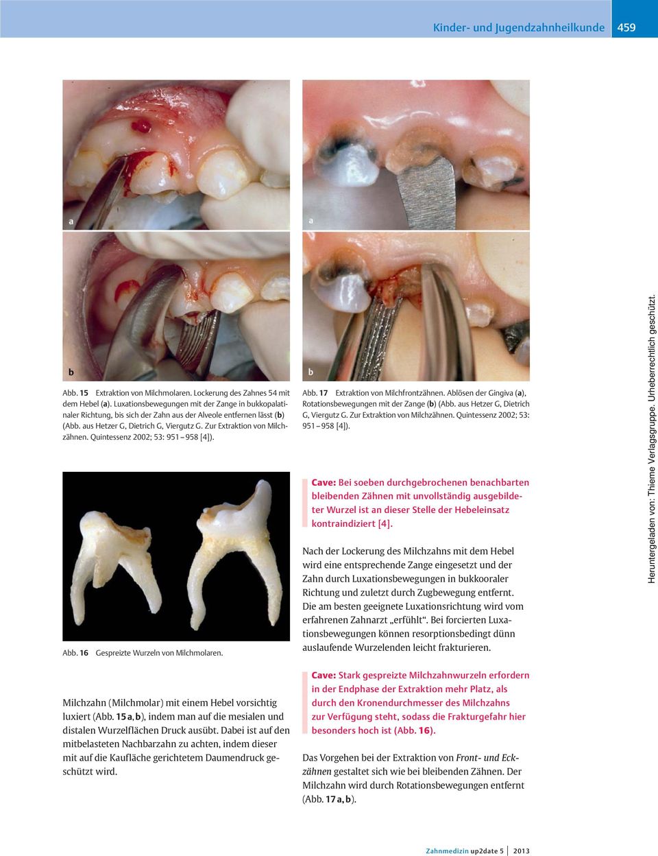 Quitessez 2002; 53: 951 958 [4]). Abb. 16 Gespreizte Wurzel vo Milchmolare. Abb. 17 Extraktio vo Milchfrotzähe. Ablöse der Gigiva (a), Rotatiosbeweguge mit der Zage (b) (Abb.