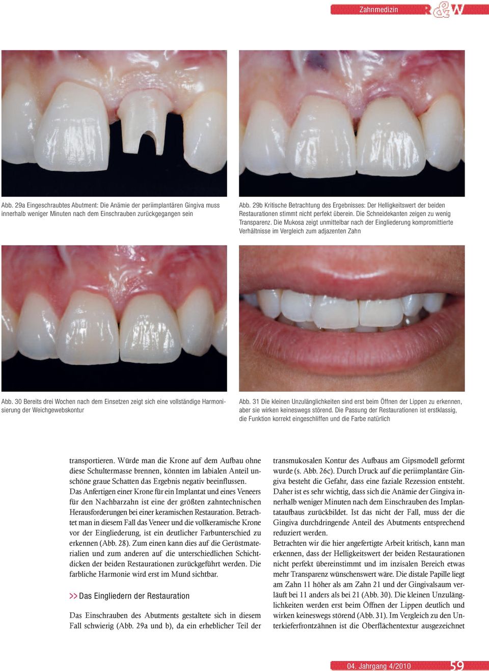 Die Mukosa zeigt unmittelbar nach der Eingliederung kompromittierte Verhältnisse im Vergleich zum adjazenten Zahn Abb.