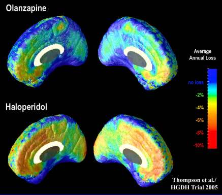 Effekte von Olanzapin auf die Hirnveränderung Lieberman et al, Antipsychotic Drug