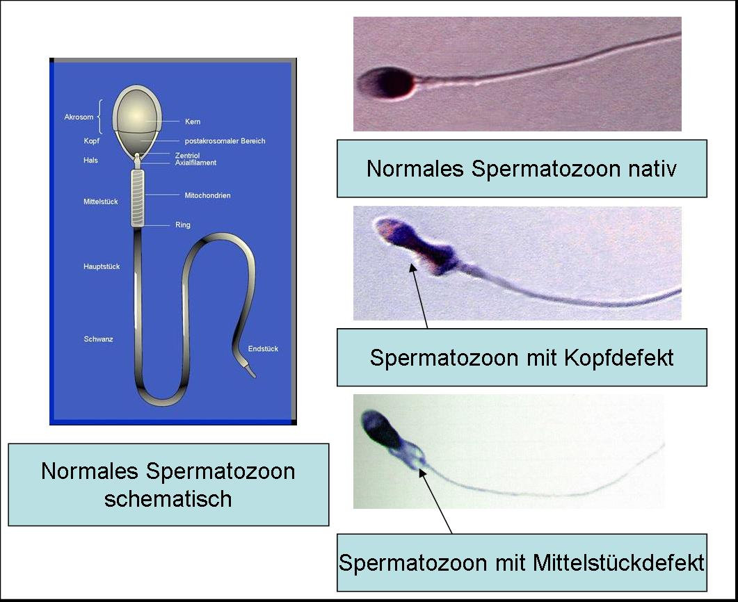 2.6.5 Lichtmikroskopische morphologische Charakterisierung der Spermatozoen FÄr die intracytoplasmatische Spermatozoeninjektion wurden mñglichst nur mikroskopisch, morphologisch normale Spermatozoen