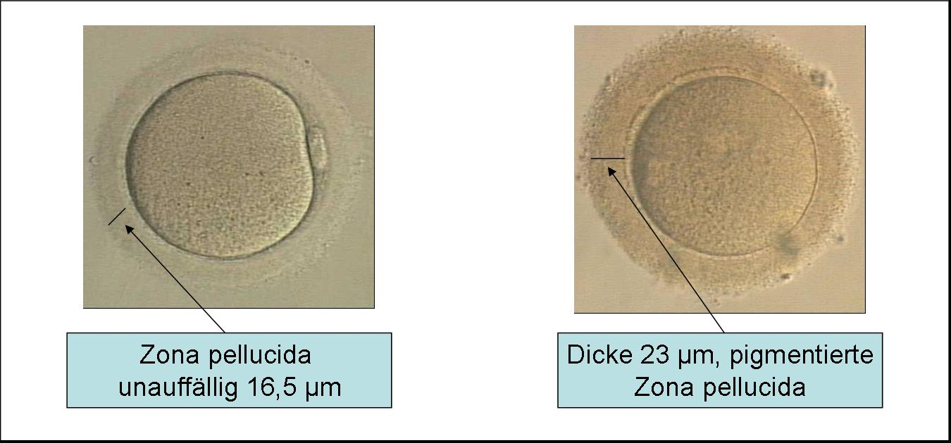 Abb.12: Normale Oozyte links und Riesenoozyte rechts im Vergleich 2.6.8.7 Dicke und Beschaffenheit der Zona pellucida Die Dicke der Zona pellucida variiert in der Regel zwischen 5 und 20 Œm.