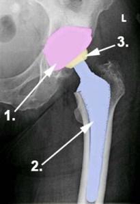 Hüftgelenkstotalendoprothese ( TEP ) Definition: Unter einer Hüftprothese (künstliches Hüftgelenk) versteht man den Ersatz des Gelenks durch künstliche Elemente.