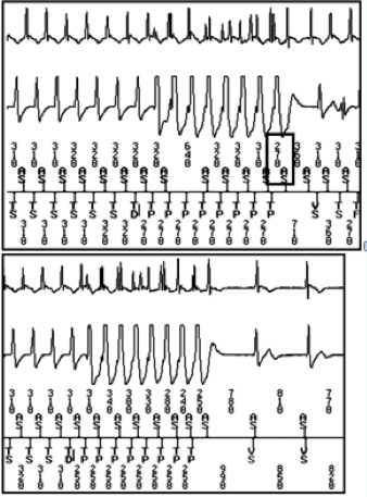 12 Antitachykardie-Pacing (ATP) Schmerzfreie Termination der Tachykardie Akzelleration in