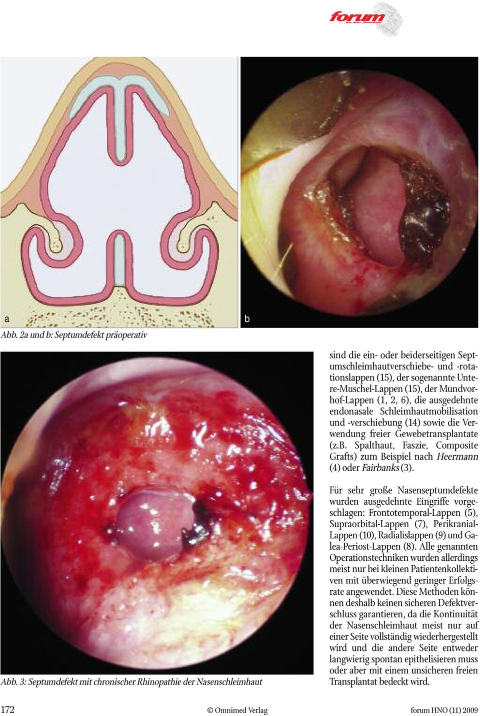 3: Septumdefekt mit chronischer Rhinopthie der Nsenschleimhut Für sehr große Nsenseptumdefekte wurden usgedehnte Eingriffe vorgeschlgen: Frontotemporl-Lppen (5), Suproritl-Lppen (7), Perikrnil- Lppen