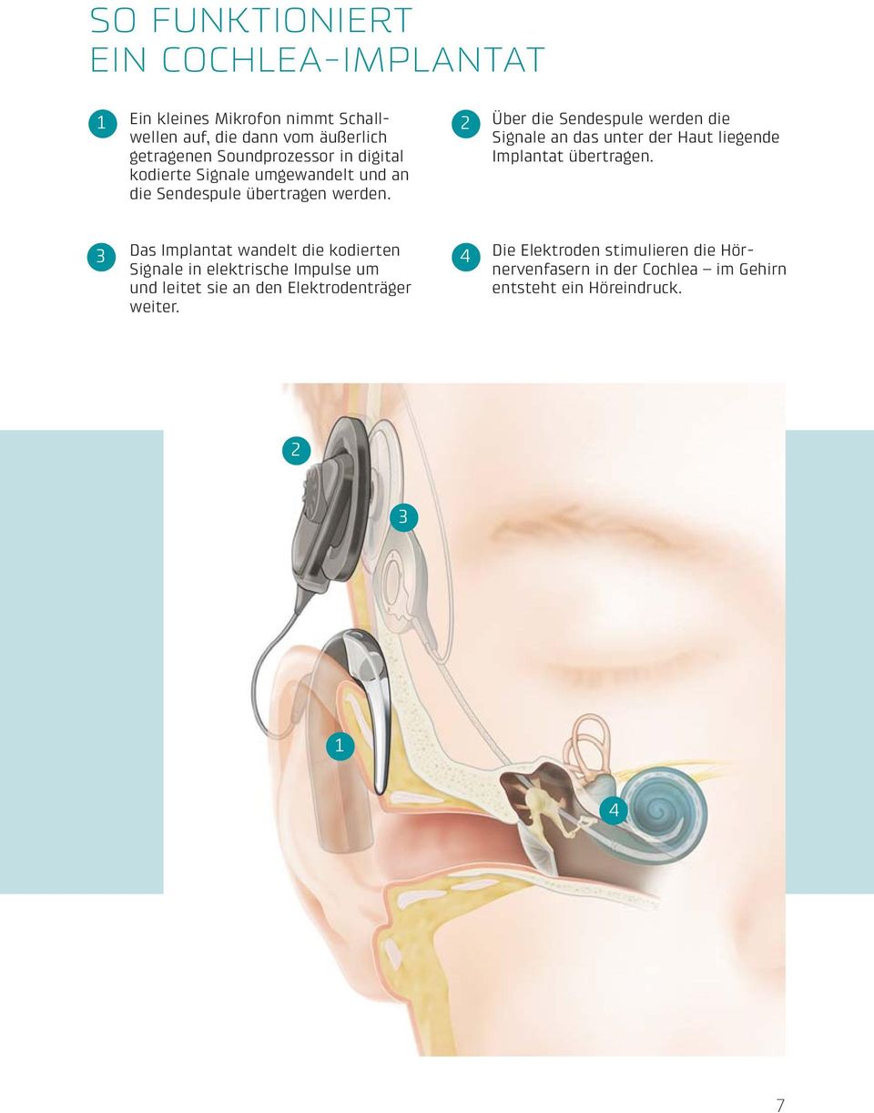 2 Über die Sendespule werden die Signale an das unter der Haut liegende Implantat übertragen.