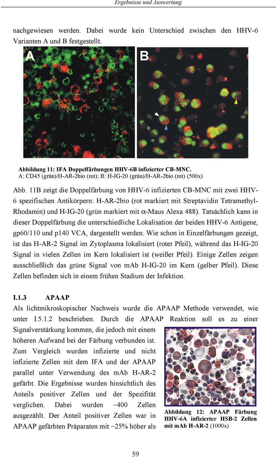 11B zeigt die Doppelfärbung von HHV-6 infizierten CB-MNC mit zwei HHV- 6 spezifischen Antikörpern: H-AR-2bio (rot markiert mit Streptavidin Tetramethyl- Rhodamin) und H-IG-2 (grün markiert mit α-maus
