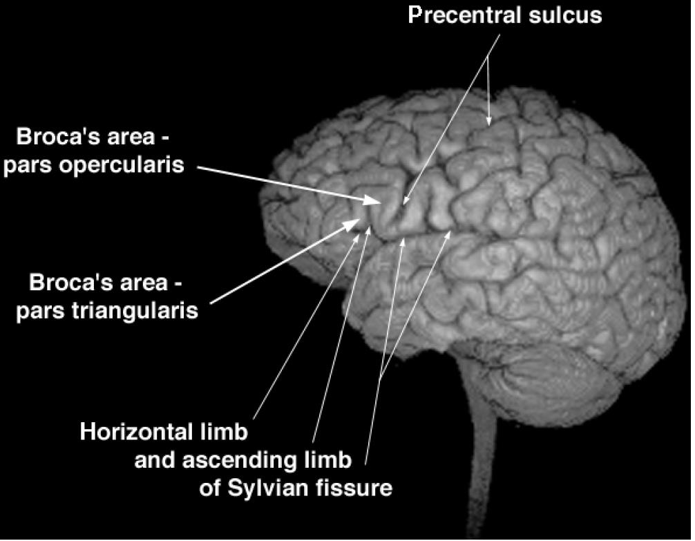Brain damage beyond Broca s area in