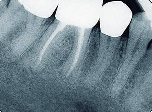 Abb. 2b: Zahn 15 nach 11 Monaten, apikales Parodont weitgehend regeneriert Abb. 3a Zahn 46 nach Trepanation, apikale Prozesse an mesialer und distaler Wurzel Abb.