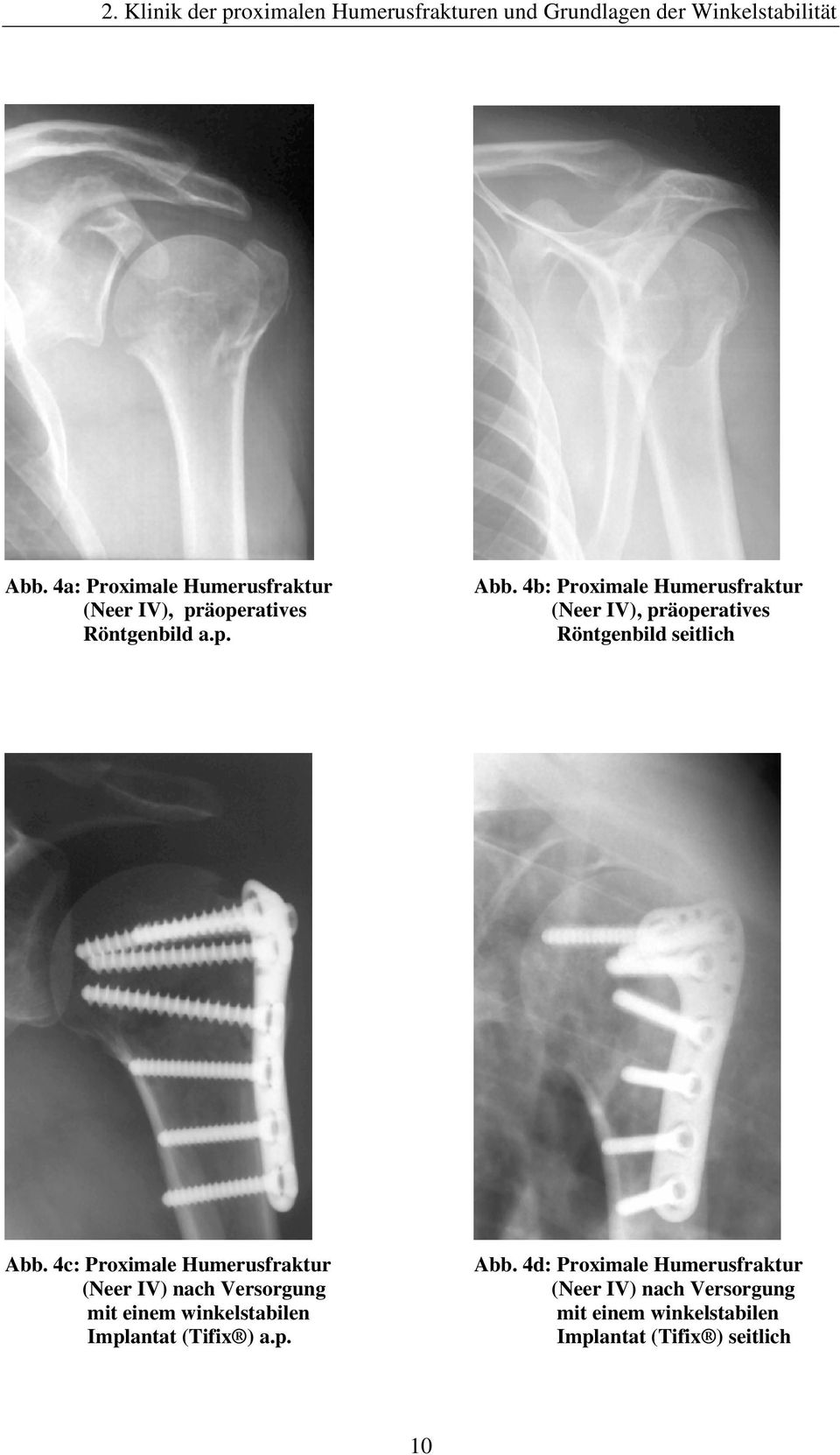 4b: Proximale Humerusfraktur (Neer IV), präoperatives Röntgenbild seitlich Abb.