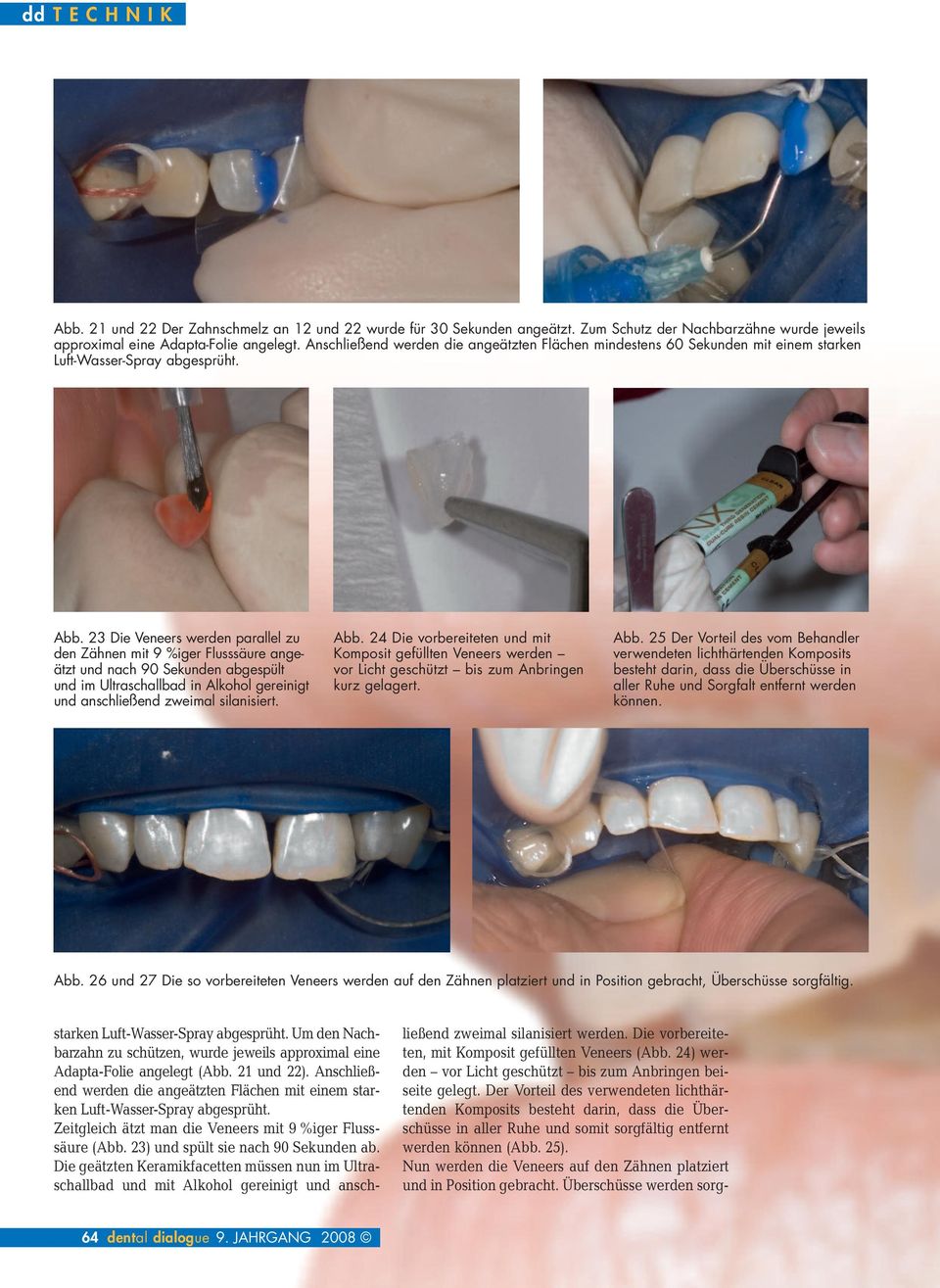 23 Die Veneers werden parallel zu den Zähnen mit 9 %iger Flusssäure angeätzt und nach 90 Sekunden abgespült und im Ultraschallbad in Alkohol gereinigt und anschließend zweimal silanisiert. Abb.