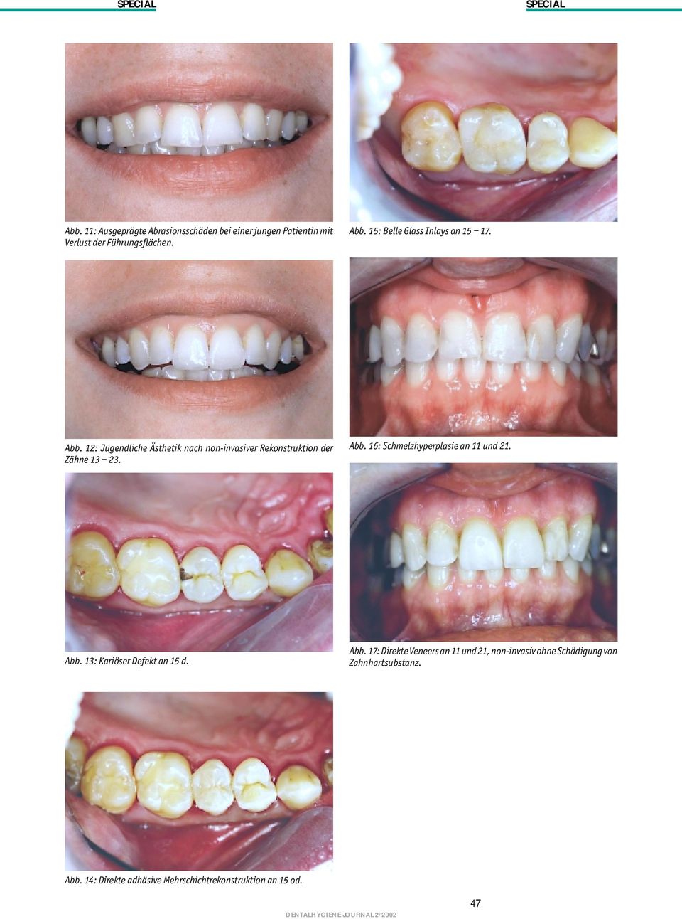 12: Jugendliche Ästhetik nach non-invasiver Rekonstruktion der Zähne 13 23. Abb.