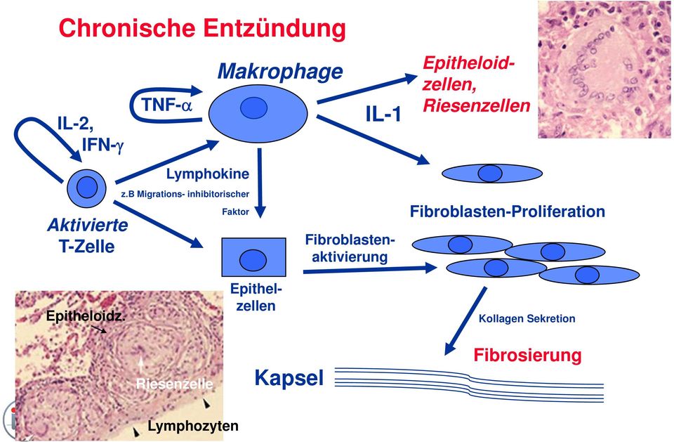 Fibroblastenaktivierung Epitheloidzellen, Riesenzellen FAF