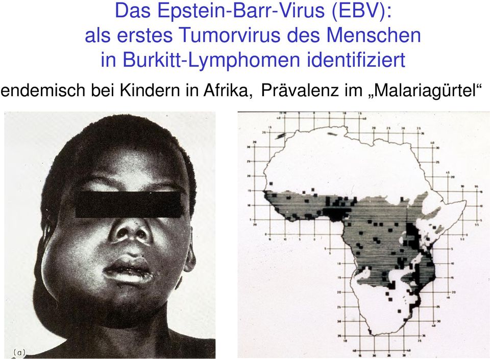Burkitt-Lymphomen identifiziert