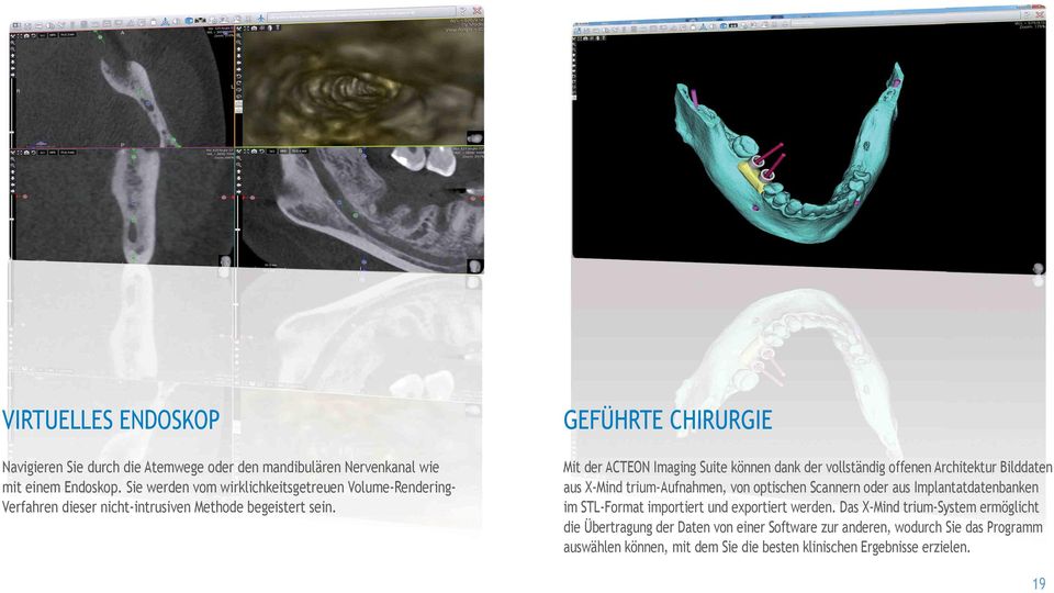 GEFÜHRTE CHIRURGIE Mit der ACTEON Imaging Suite können dank der vollständig offenen Architektur Bilddaten aus X-Mind trium-aufnahmen, von optischen Scannern oder