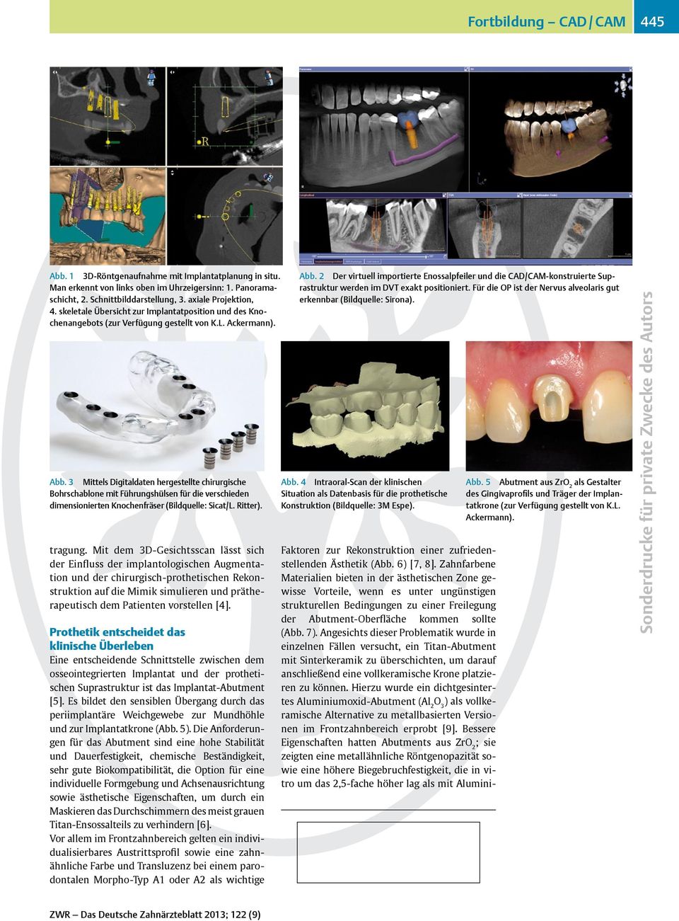 3 Mittels Digitaldaten hergestellte chirurgische Bohrschablone mit Führungshülsen für die verschieden dimensionierten Knochenfräser (Bildquelle: Sicat/L. Ritter). tragung.