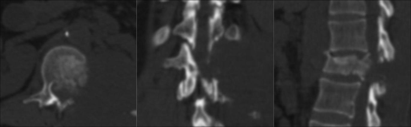 Knochen SPECT-CT: Osteoblast