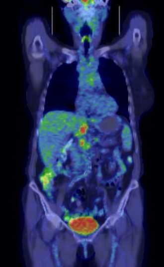 FDG-PET in der Onkologie
